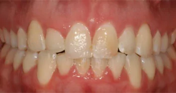 Smile reconstruction in Casper WY: after