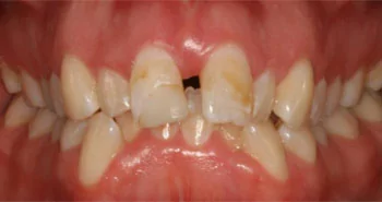 Smile reconstruction in Casper WY: before