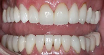 Real patient results - Porcelain veneers: after