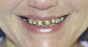 Real patient results - Porcelain veneers: before