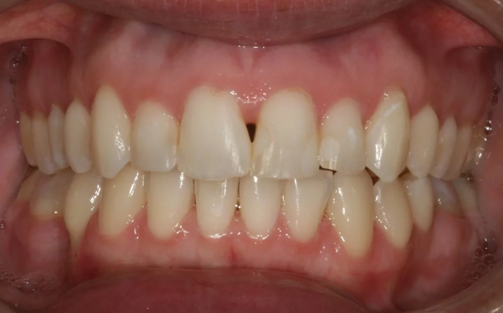 straight teeth in Casper: after