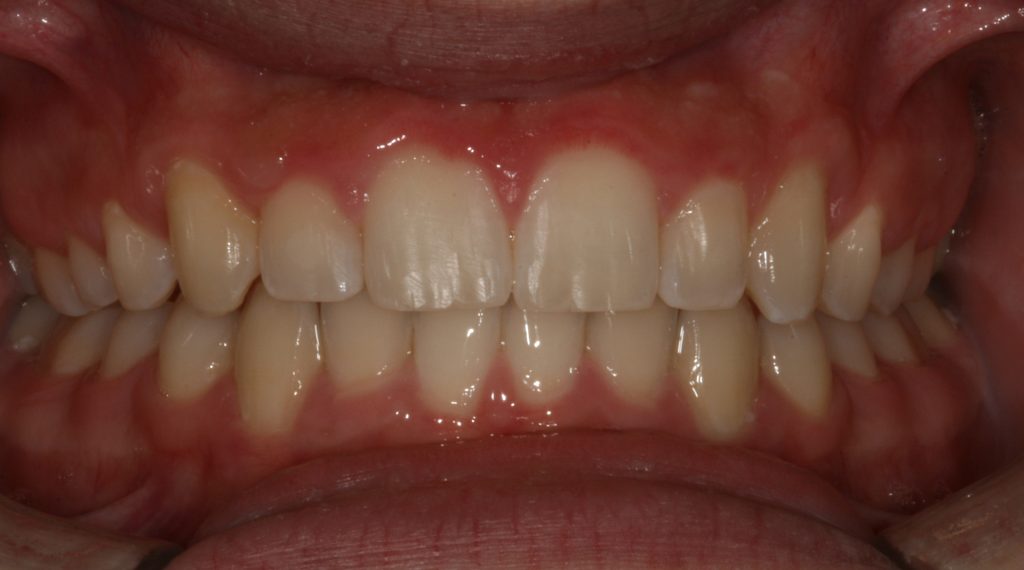 Orthodontics in Casper WY: after