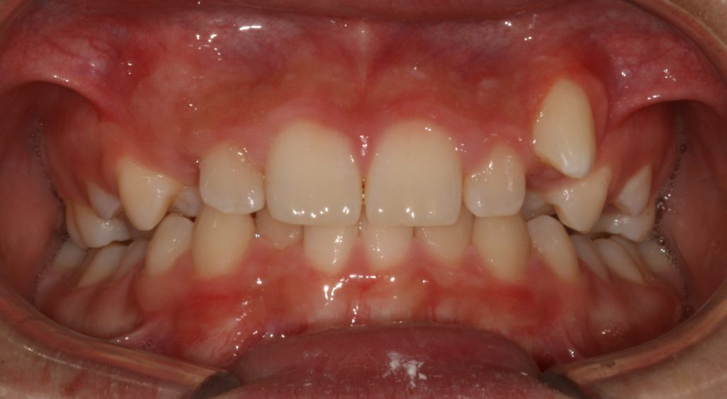 Orthodontics in Casper WY: before