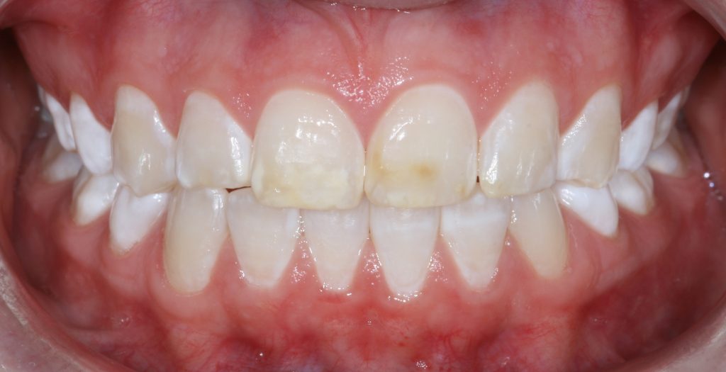 Dental Crowns in Casper WY: before