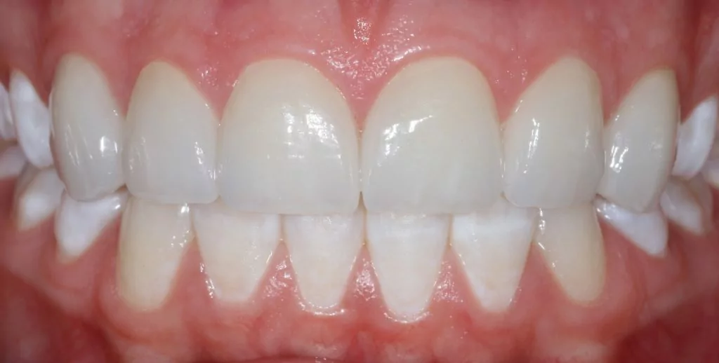 Dental Crowns in Casper WY: after