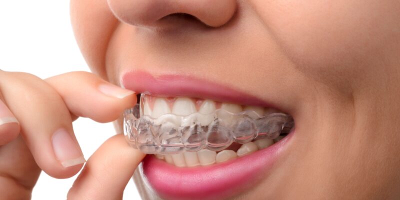 A woman inserting a clear aligner.